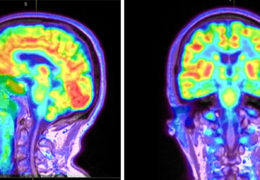 PET scan of a brain. Various regions of the brain are different colors to show activation.