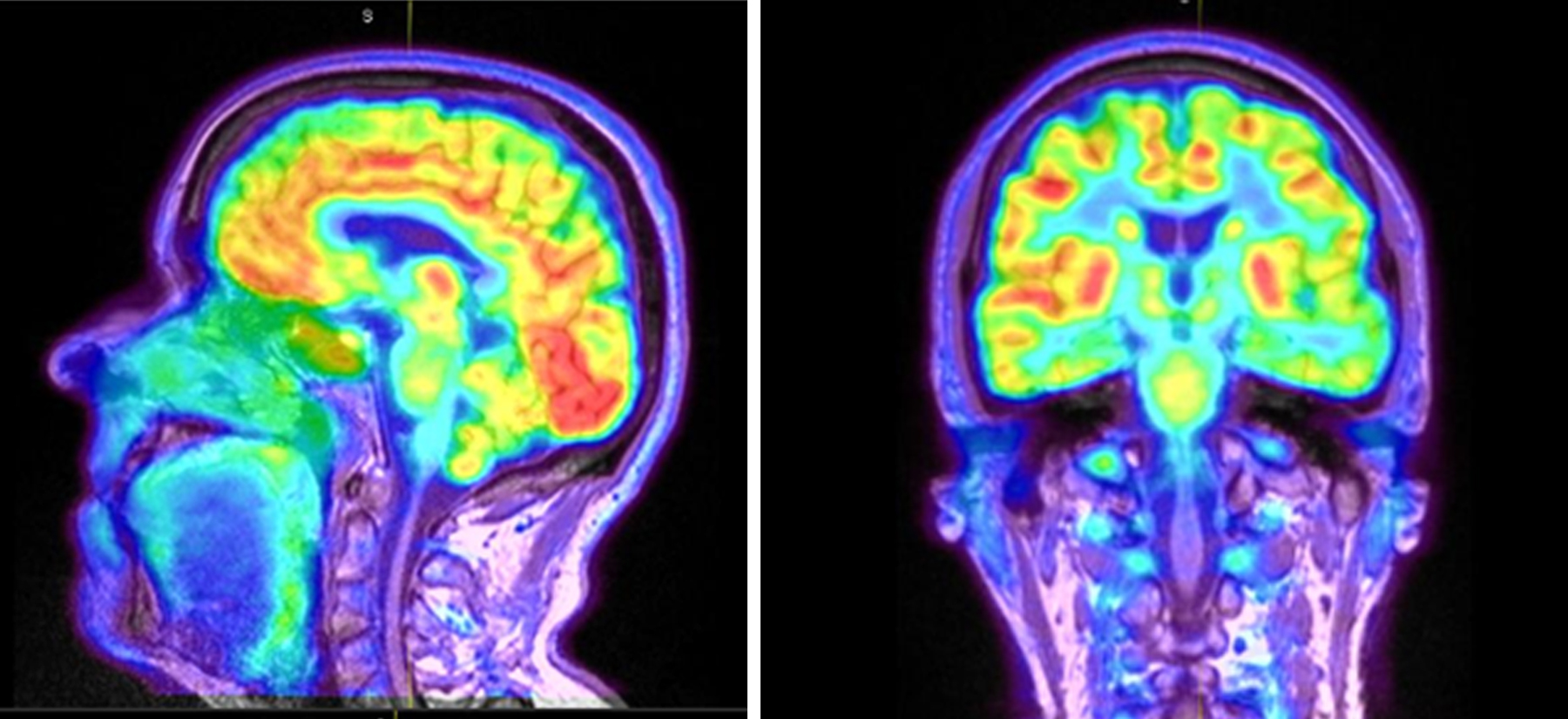 PET scan of a brain. Various regions of the brain are different colors to show activation.