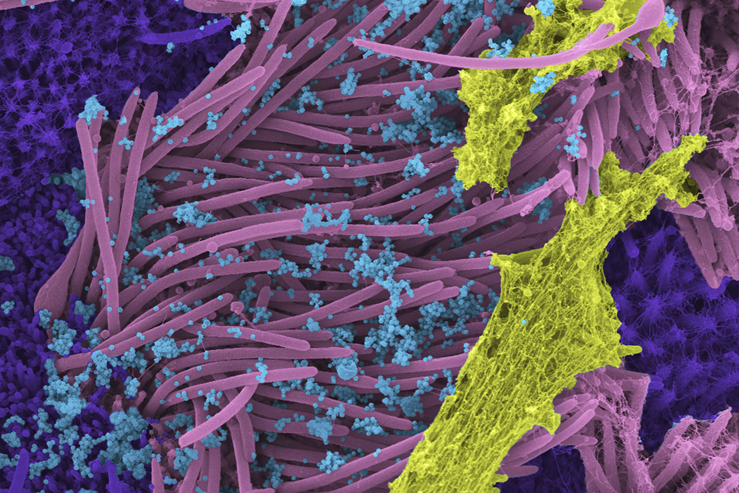 scanning electron microscope image of lung cells being attacked by SARS-CoV-2