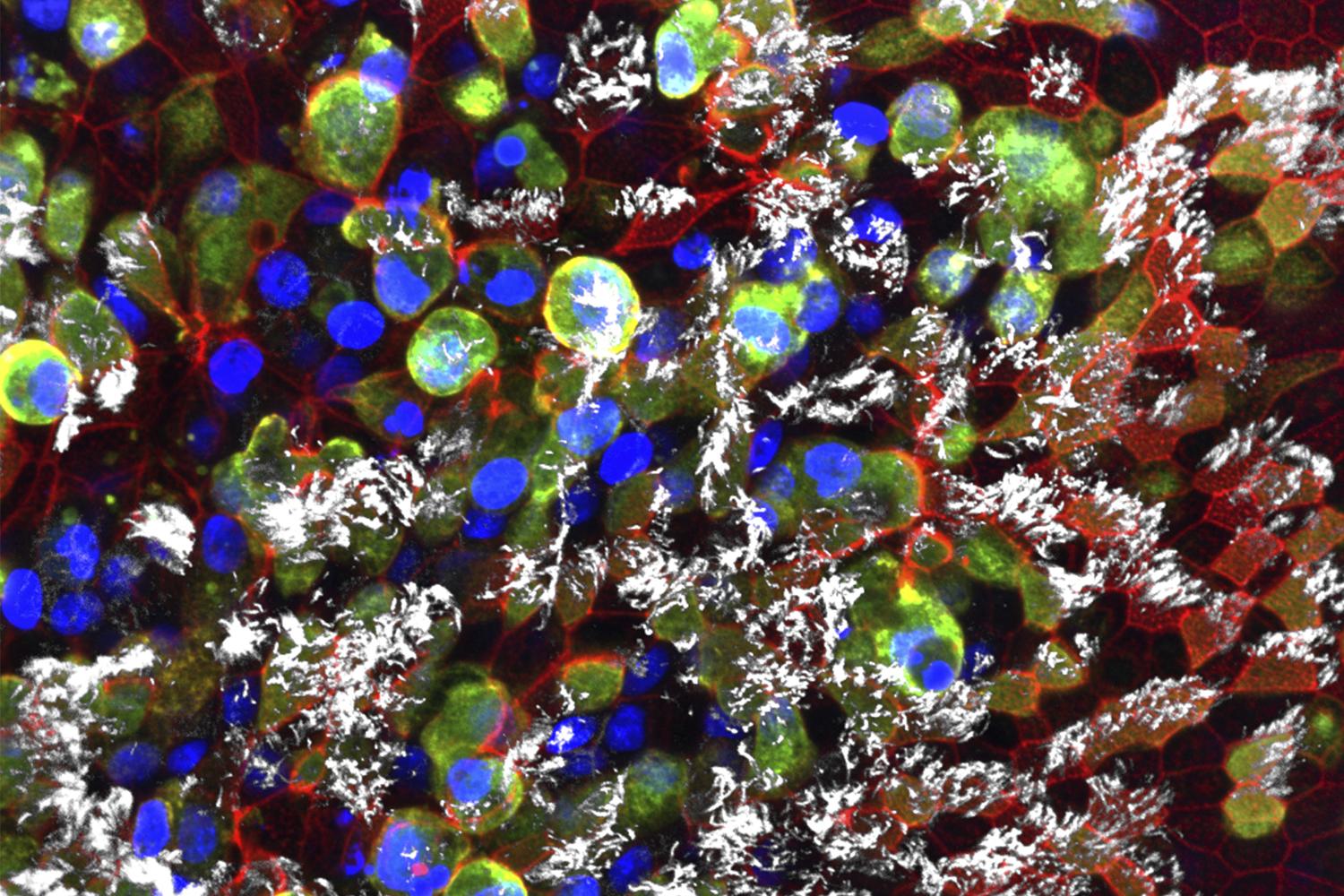 confocal microscope image of SARS-CoV-2 attacking lung cells