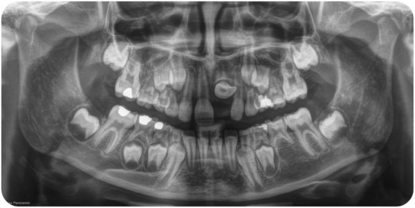 x-ray of Victoria Griner's mouth