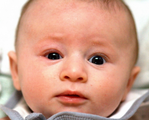 Photo of a baby with an eye infection.
